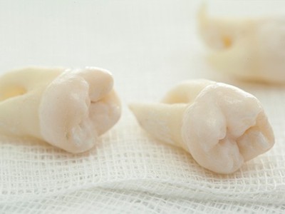 智齒疼了，這牙非拔不可嗎？