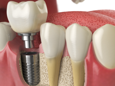 選擇種植牙后要做哪些日常維護(hù)？