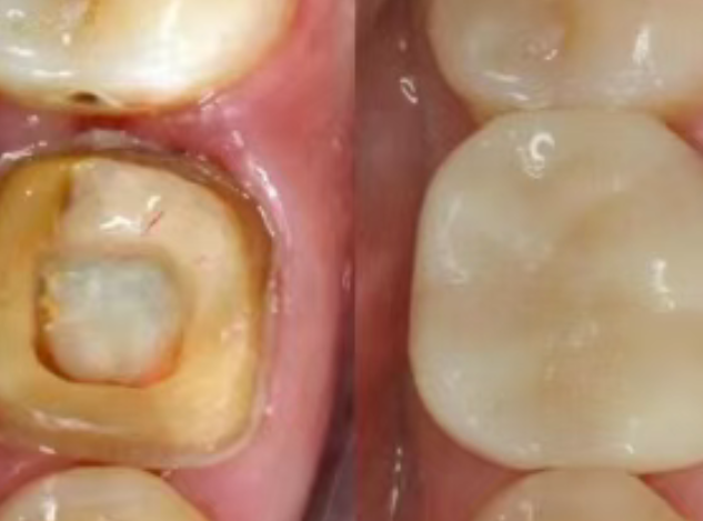 根管治療（抽神經(jīng)）后，為什么一定要做牙冠？