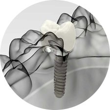 術前研究、模擬提升種植成功率