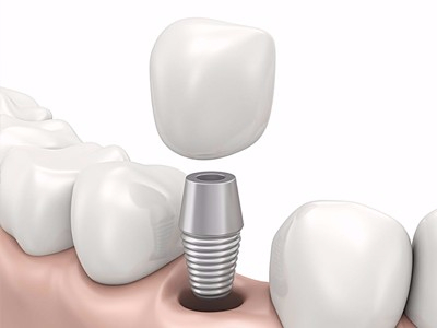 在承德哪家口腔醫(yī)院口腔種植齒好一點，惟德口腔醫(yī)院值得您的選擇