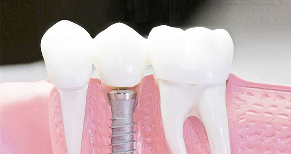 在承德口腔種植牙齒需要多少錢？惟德口腔一一為您道來