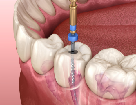根管治療后的注意事項有哪些？